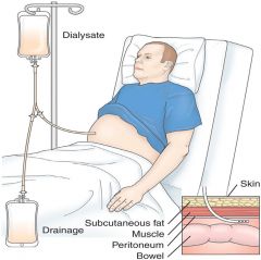 The peritoneum acts as the semipermeable membrane to achieve dialysis. Solutes move via osmosis. PD occurs via the transfer of fluid & solute from the bloodstream through the peritoneum into the dialysate solution.