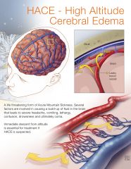 encephalopathy
vasogenic  edema