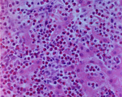 What type cellular infiltration is seen here?


What might this be indicative of? 