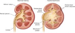 Expansion of the kidney with urine