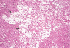 Given that this is liver what is accumulated in these cells?


What is a differentiating feature?