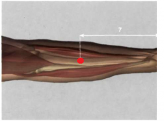 7 Tsun por encima del pliegue de flexión distal de la articulación de la muñeca, en la parte radial interna del
antebrazo, sobre la línea de unión entre P5 y P9