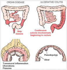 ulcerative colitis:
-begins in distal rectum & spreads into colon
-does NOT involve small intestine
-characterized by continuous inflammatory lesions involving mucosa & submucosa only

Crohn's disease
-involves terminal ileum & colon
-chara...