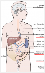 complications:
-esophageal varices (at gastroesophageal junction)--> fatal hemorrhage
-caput medusae (subcutaneous veins radiate out from umbilicus, secondary to paraumbilical veins)
-hemorrhoids (at anorectal junction)

treatment:
-portosys...
