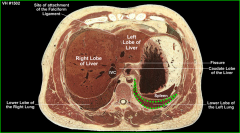 entering the pleural cavity which would cause pleuritis