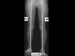 Proximal femur – 3mm per year
Distal femur – 9mm per year
Proximal tibia - 6mm per year
Distal tibia – 5mm per year. Tot=23
In this question, the boy has 7 years of growth remaining with a predicted arrest thru his distal femoral physis....