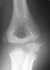 Hx: 36yo M c/o L hand weakness. A current clnical photograph of his hand is ulnar claw-hand deformity, medical history is(+) for the elbow injury Fig, which was treated non-op 28 yrs prior. Current xray evaluation of the patients elbow will most l...