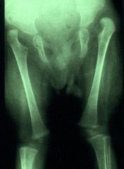 Hx:5yo B has a hx of b/l dislocated radial heads, b/l knee dislocations, and flattened facies. What other important orthopaedic-related condition must be checked in this patient? 1-congenital vertical talus 
2-congenital trigger thumb; 3-tibial h...
