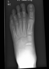 Hx:5-yo B c/o a limp and pain over the medial aspect of the foot. xrays fig A and B. Orthotics have failed to improve his symptoms. What is the next appropriate management of this condition? 1-core decompression; 2-triple arthrodesis; 3-subtalar f...