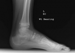osteonecrosis of the navicular bone, otherwise known as Kohler’s disease. Treatment is traditionally symptomatic and pain usually can be relieved by limiting activities, and using orthotics. If this does not work, then a short leg walking cast f...