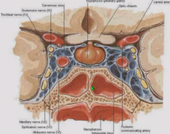 Carotid sinus is lateral to pituitary - pituitary tumor can cause cranial nerve palsies and affect blood flow.
Sinus also provides surgical access to pituitary
