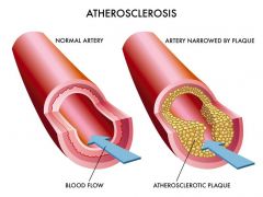 By lesions called Atherosclerotic Plaques (Atheromas)