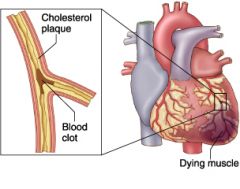 Death of myocardial tissue due to lack of blood supply to the heart