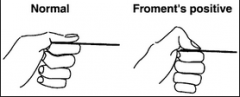 Finger a piece of paper - if Ulnar nerve injury then the thumb will bend to keep a hold onto the paper 