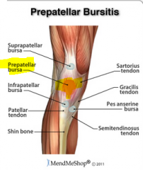 Housemaid's knee (i.e Prepatellar bursitis ) 