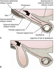 Scrotal hernias are indirect hernias that result from a defect in the vaginal ring, allowing abdominal contents to protrude into the vaginal process alongside spermatic cord contents

Herniated organs within the vaginal process do not necessaril...