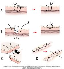 when wound edges are not opposed in level fashion

epithelialiazation is delayed

1.bites at same depth on either side of incision
2.half buried horizontal mattress sutures
3.stiff suture across wound to elevate low side