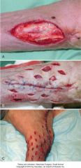 intially wound edges are undermined. 
then 1cm stab incisions 1 cm from wound edge and 1 cm apart. rows should be staggered.

can mesh circumferentially in a limb

oclussive bandage placed until epithelialization

skin can look bad for a few days b