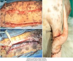 used to transfer skin to a distant site when there is no immediate need to cover an area

two parallel incisions are made in mobile ski. the flap is rolled into a tube and ends are sutured together. the underliying defect is undermined and closed primar