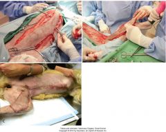 skin incised on midline  beginning just behind caudal teat (base of prepuce included in male dogs).  maximum flap length is to second teat
ditance between teat and midline is measured and equidsitant incision is made lateral to teat
flap undermined deep