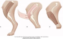 base of flap 1cm proximal to patella
and 1.5 cm distal to tib tub on lateral aspect
dorsal and ventral incisions parallel to femoral shaft

keep flap short