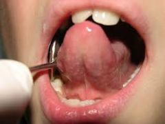 El frenillo lingual es un fino repliegue, en forma de membrana, que ancla la lengua al suelo de la boca. Está presente de forma normal en todas las personas, pero cuando es anormalmente corto puede limitar el movimiento normal de la lengua. Este ...
