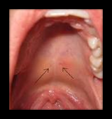 the palate appears normal becausethe tissue covering the palate hides a cleft of the hard palate, the softpalate, or both.