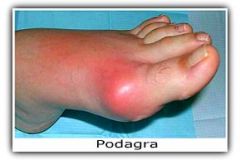 1. Asymptomatic hyperuricemia- increased serum uric acid level in the absence of clinical findings or gout, may be present without symptoms for 10-20 years or longer. Should not be treated because over 95% of patient remain asx
2. Acute gouty art...
