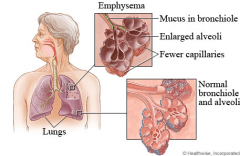 Pulmonary Emphysema