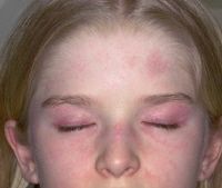 1. heliptrope rash (butterfly) - around eyes, bridge of nose, and cheeks
2. gottron's papules- papular erythematous, scaly lesions over the knuckles (MCP, PIP, DIP)
3. V sign - rash on face, neck, and anterior chest
4. shawl sign- rash on the s...