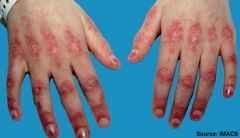 seen in dermatomyositis - papular, erythematous, scaly lesions over the knuckles