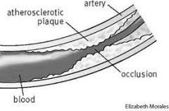 Atherosclerosis is when plaque builds up in the arteries.
