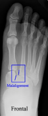 Midfoot injury resulting in metatarsal dislocation 