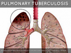 Pulmonary Tuburculosis