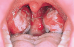 Infectious Mononucleosis: Epstein--Barr Virus Infection