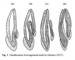 - 0.3 to 10%
- Most common in maxillary lateral incisors
- 79% Type I, 15% Type II and 5% Type III

Alani and Bishop IEJ 2008, Hulsmann IEJ 1997
