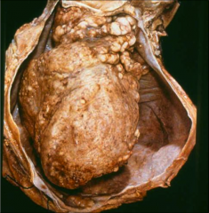 This is the heart from a 45 YO TB+ man. What happened?