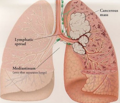 Lung Cancer (1)