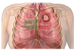 Lung Cancer (2)