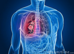 Lung Cancer (3)