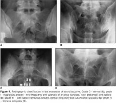Imaging studies of the lumbar spin and pelvis (plain film, MRI and CT) reveal sacroiliitis - sclerotic changes in the sacroiliac area. Eventually, the vertebral columns fuse and produce a "bamboo spine"
2. Elevated ESR in up to 75% of patients du...
