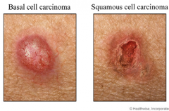 Non-melanoma Skin Cancers (Basal Cell Carcinoma and Squamous Cell Carcinoma)