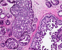 What does this carcinoma in situ show (nuclei)?