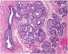 This carcinoma in situ has numerous ______. They are small round dark thing. How many are there?