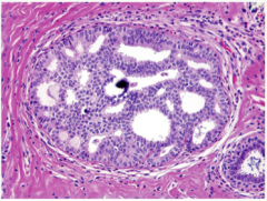 Again, what type of hyperplasia? Comment on the lumens (can they have a cribriform pattern)? What is the dark purple thing in the middle of the picture?