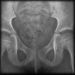 Which of the following is true regarding the structure outlined in Figure A? 1-It is comprised of the iliopectineal eminence and quadrilateral surface; 2-In normal hips, all children usually have this radiographic figure by 18 months of age; 3-  T...