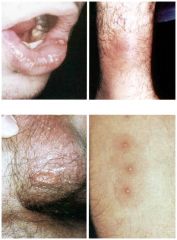 1. An autoimmune multisystem vasculitic disease, cause is unknown
2. Clinical features: recurrent oral and genital ulcerations (usually painful), arthritis (knees and ankles most commonly), eye involvement (uveitis, optic neuritis, iritis, conjuc...