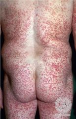 - small vessel vasculitis that is a hypersensitivity reaction in response to a drug (penicillin, sulfa drugs), infection or other stimulus
- skin is predominantly involved - palpable purpura, macules or vesicles (common on lower extremities) can ...