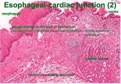 esophageal (cardiac junction)... eso is thick, cardia thinner epi