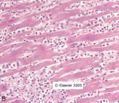 Bildet viser infiltrat av nøytrofile granulocytter i interstitiet mellom kardiomyocytter etter et infarkt. Omtrent hvor gammelt er dette infarktet?